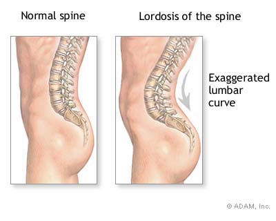 Spinal Lordosis