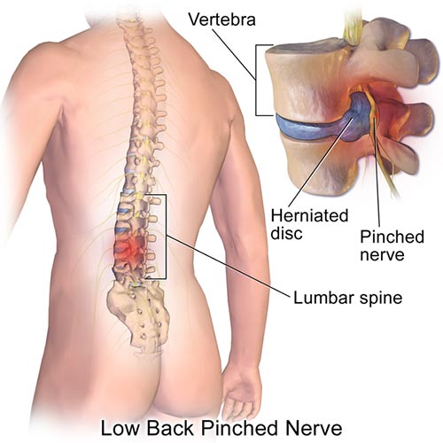mri lower back pain
