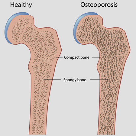 Osteoporosis diagram